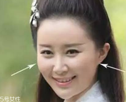 颧骨高适合垫鼻子吗,颧骨高的人不好吗 颧骨高适合垫鼻子吗,颧骨高的人不好吗