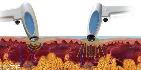 溶脂针打了会反弹吗,射频溶脂会反弹吗 溶脂针打了会反弹吗,射频溶脂会反弹吗