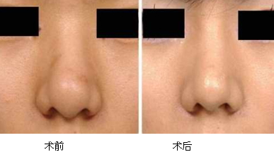 瘦脸针效果对比图,7d聚拉提效果对比图 瘦脸针效果对比图,7d聚拉提效果对比图