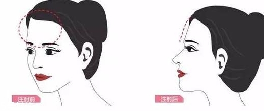 丰额头针多少钱,丰额头的费用