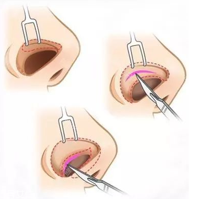垫鼻子 假体,什么是假体隆鼻