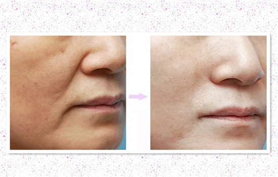 脂肪填充苹果肌后法令纹加深,填充苹果肌可以改善法令纹吗
