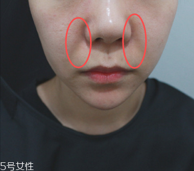 法令纹填充后脸更臃肿,填充法令纹后脸型变了 法令纹填充后脸更臃肿,填充法令纹后脸型变了