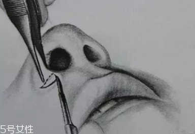外切鼻翼多久才能完全消肿,鼻子如何快速消肿