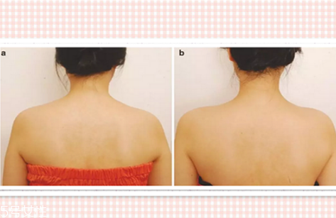 瘦肩针效果好吗,瘦肩针有效果吗