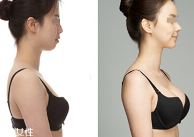 自体脂肪丰胸后怎么护理,自体脂肪丰胸后需要注意什么 自体脂肪丰胸后怎么护理,自体脂肪丰胸后需要注意什么