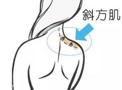 瘦肩针原理,瘦肩针原理 和副作用