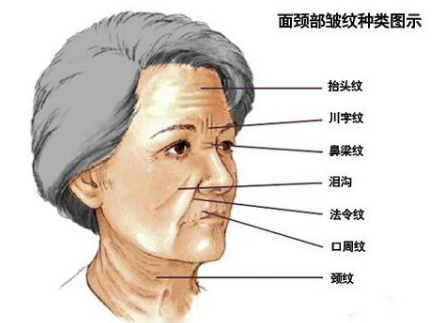 玻尿酸去除川字纹,川字纹玻尿酸填充手法 玻尿酸去除川字纹,川字纹玻尿酸填充手法