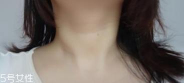 颈部除皱 最有效方法,颈部除皱手术要多少钱 颈部除皱 最有效方法,颈部除皱手术要多少钱