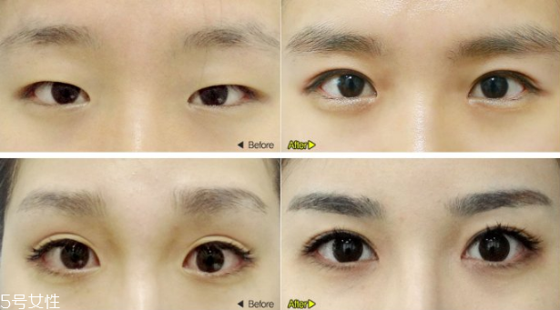 韩式双眼皮和欧式双眼皮的区别,传统双眼皮和韩式双眼皮的区别