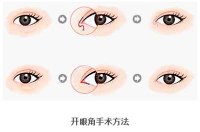 开眼角需要注意什么,开眼角要注意些什么