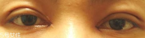 开眼角恢复过程图片,开眼角恢复十天过程图