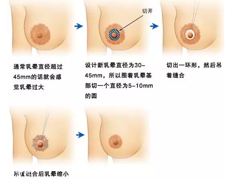 乳晕缩小术会留疤,乳晕缩小术价格