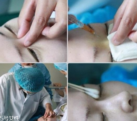 玻尿酸停止注射后危害,注射玻尿酸能维持多长时间