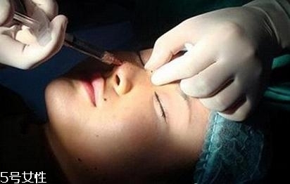 玻尿酸隆鼻会不会鼻梁越来越宽,玻尿酸注射鼻子会变宽吗