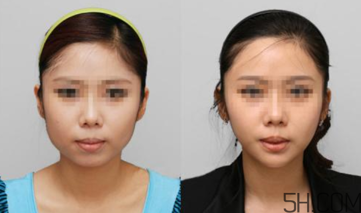 瘦脸针小知识,瘦脸针注意什么