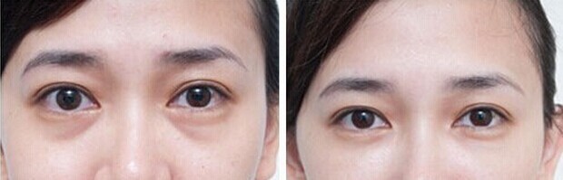 玻尿酸打泪沟打成了眼袋,泪沟打完玻尿酸像眼袋怎么办