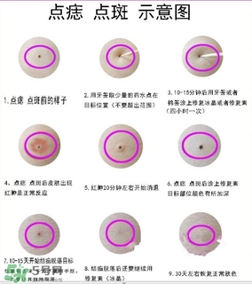 药水点痣和激光点痣的原理是什么,药水点痣和激光点痣的区别