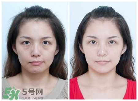 线雕后可以敷面膜吗,做完线雕可以敷医用面膜吗