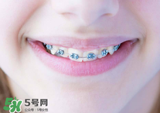 戴牙套的坏处有哪些,带钢牙套的好处和坏处