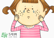 激光祛痘多久能恢复,激光祛痘多久见效果