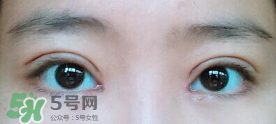 开眼角都会有疤痕增生吗,疤痕体质的人开眼角增生了能好吗