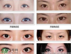 开眼角手术怎么做,做开眼角手术要注意什么 开眼角手术怎么做,做开眼角手术要注意什么