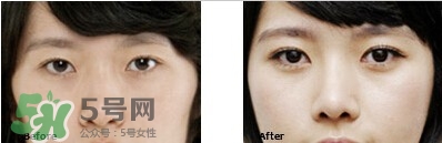 开眼角有几种方式,什么样适合开眼角