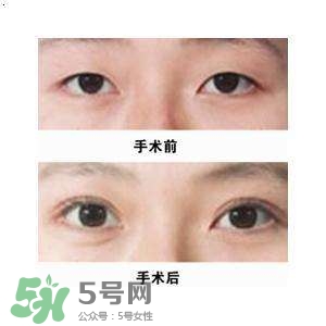 割双眼皮疼几天能好,割双眼皮要疼几天能好