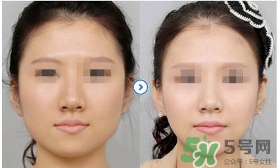 瘦脸针注意事项有哪些呢,瘦脸针注意事项禁忌症