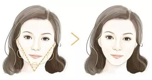 瘦脸针有效果吗?,瘦脸针效果如何