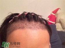 植发需要剃光头吗,植发需要把头发剃光吗