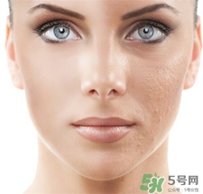 点阵激光后注意事项防晒要多久,激光点阵后需要注意什么