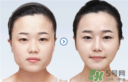 botox瘦脸针怎么样,botox瘦脸针是什么牌子