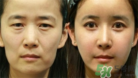 童颜针的功效及副作用,童颜针的副作用