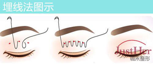 定点双眼皮怎么做,双眼皮定点是怎么弄的