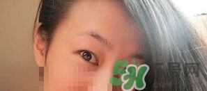 定点双眼皮恢复过程图 一个月,定点双眼皮修复过程图