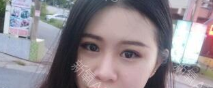 定点双眼皮不要了可以拆掉吗,做双眼皮三点定位是永久的吗