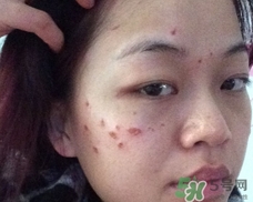 激光点痣贵不贵,哪里可以激光点痣