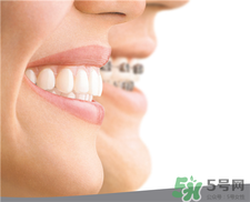 戴着隐适美吃东西,带隐适美可以吃饭吗