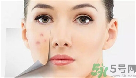 激光祛痘会反弹吗,激光治疗痘痘会复发吗 激光祛痘会反弹吗,激光治疗痘痘会复发吗