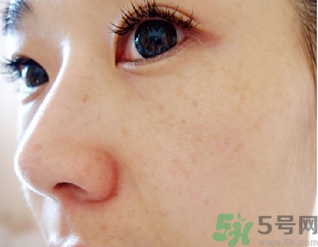 激光祛斑会反弹吗?,激光祛斑会反弹吗有副作用吗