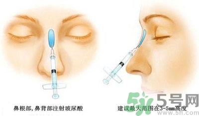 打玻尿酸能维持多久呢,注射一次玻尿酸能维持多久
