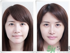 玻尿酸打嘟嘟唇能保持多久,玻尿酸丰唇能保持多长时间