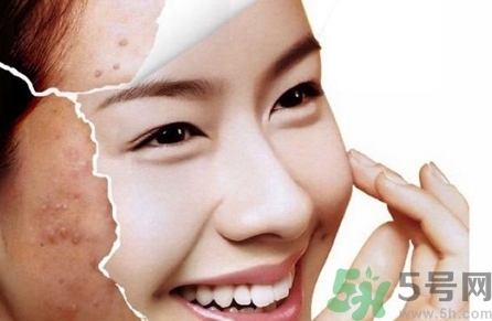 医院刷酸祛痘效果怎么样,长痘刷酸效果怎么样