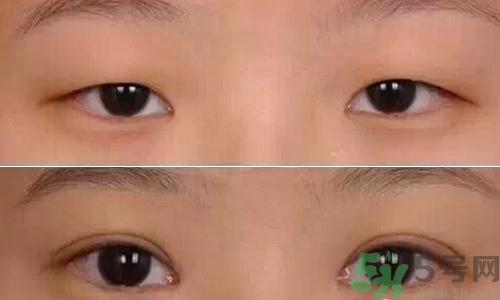 肿眼泡的类型,肿眼泡的4种类型