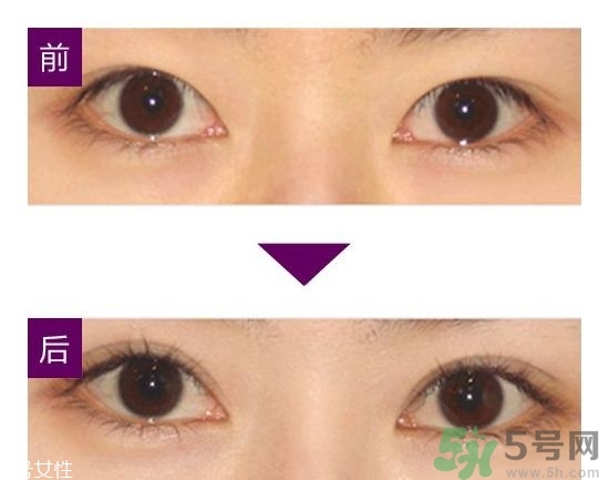 双眼皮埋线能拆吗,埋线双眼皮以后要取出来吗