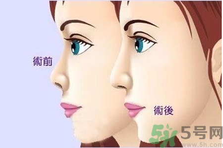 玻尿酸隆鼻教程,玻尿酸隆鼻恢复过程