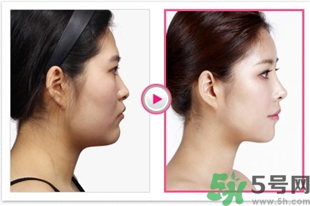 玻尿酸隆鼻的好处和坏处,玻尿酸隆鼻的危害性有哪些