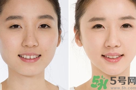 鼻子打玻尿酸的危害,玻尿酸隆鼻的危害有哪些